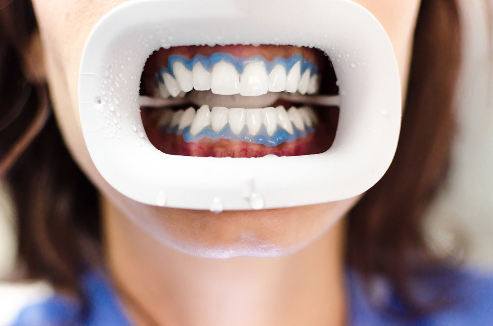 Teeth whitening