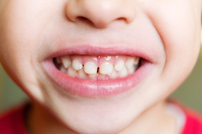 Kid's teeth